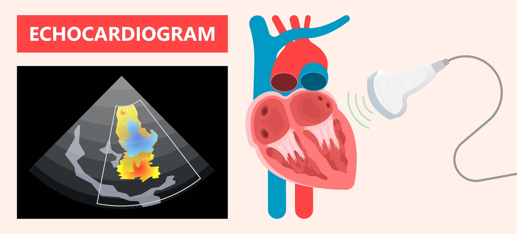 Echcardio assessment