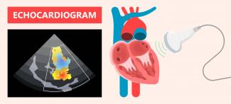 Echcardio assessment